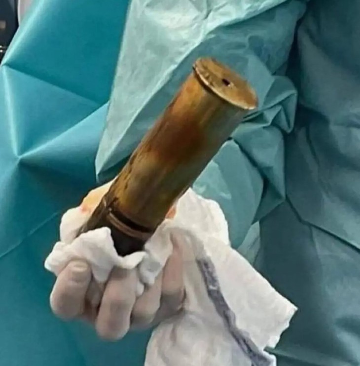 Cụ ông nhập viện với quả đạn pháo trong... trực tràng - Ảnh 1.