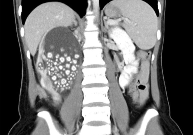 Thận phải của Xiao Mei có hàng trăm viên sỏi "chen chúc" nhau - Ảnh: Chi Mei Hospital