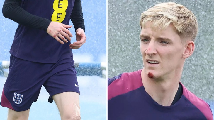 Anthony Gordon gây chú ý trong buổi tập của tuyển Anh tại Euro 2024 với những vết thương do ngã xe đạp điện