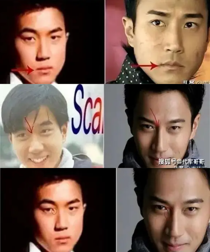 Lưu Khải Uy trước và sau phẫu thuật&nbsp;