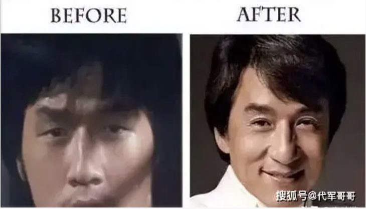 Thành Long trước và sau phẫu thuật mắt&nbsp;