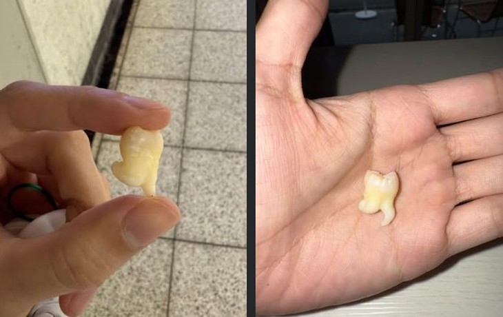 răng khôn - Ảnh 1.