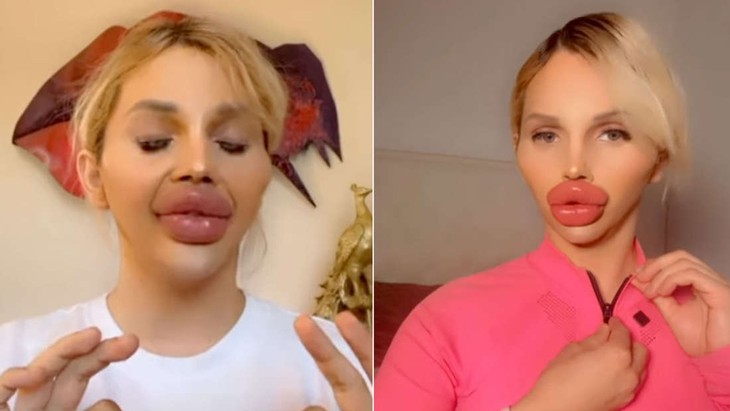 bơm môi - Ảnh 2.