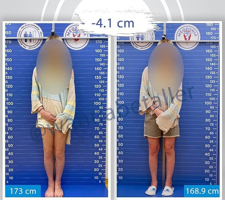 Cô gái 1m73 chi 20.000 USD cắt 4cm xương đùi để mình bớt cao - Ảnh 2.