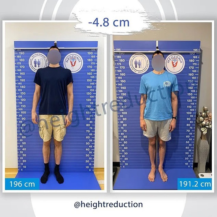 Cô gái 1m73 chi 20.000 USD cắt 4cm xương đùi để mình bớt cao - Ảnh 3.