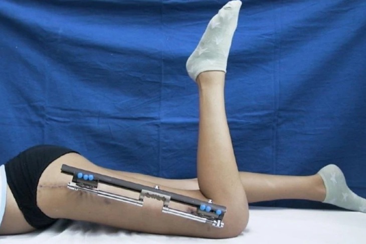 Cô gái 1m73 chi 20.000 USD cắt 4cm xương đùi để mình bớt cao - Ảnh 1.