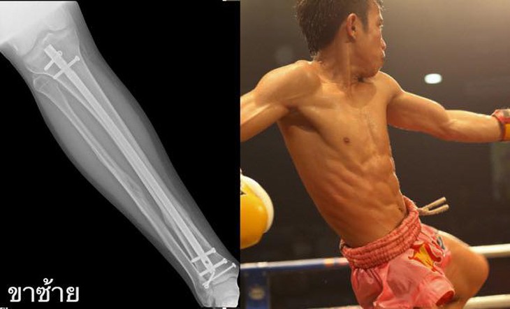 Thực hư chuyện võ sĩ Muay Thái gắn kim loại vào xương để uy lực hơn - Ảnh 2.