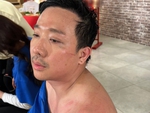 Trấn Thành bị thương tích đầy người: Ok! Không sao hết, Hai ổn!
