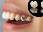 Xăm răng - xu hướng làm đẹp đang rộ lên tại một đất nước