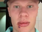 Erling Haaland khâu 3 mũi sau tai nạn hy hữu