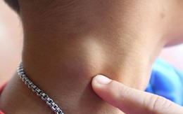 Bị hạch lao viêm sao lại ngứa khắp người?