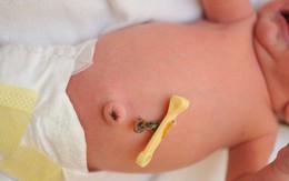 Em bé hay bị sôi bụng, bệnh lý hay bình thường?