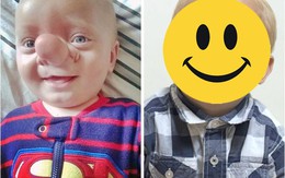 'Cậu bé Pinocchio đời thực' thay đổi bất ngờ sau nhiều năm