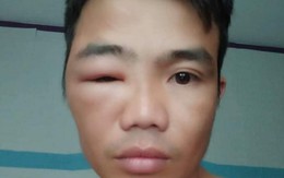 Ảnh vui 5/3: Thanh niên nhờ dân mạng 'chỉnh giúp em 2 mắt như nhau'