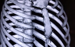 Bị bạn dùng mũi kiếm của cá kiếm đâm thấu ngực