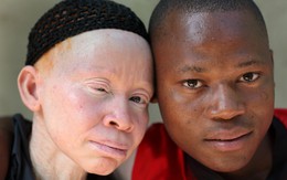 Bạch tạng và các vấn đề về mắt