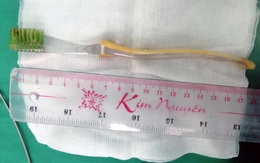 Gắp bàn chải đánh răng dài gần 20cm khỏi dạ dày bé gái 13 tuổi