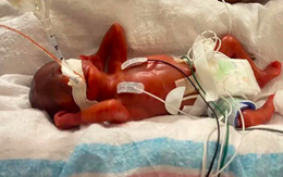 Cậu bé sinh sớm 132 ngày vào sách kỷ lục Guinness là người sinh non nhất thế giới còn sống