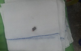 Cứu thanh niên bị đạn bắn thủng bụng, vỡ thận