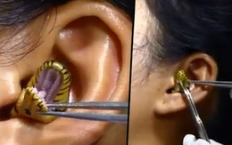 Người phụ nữ bị con rắn chui tọt vào lỗ tai