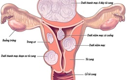 Có nhân xơ tử cung, khả năng mang thai tự nhiên thế nào?
