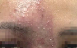 Tiêm filler nâng mũi 'ủng hộ' spa quen, ngờ đâu hoại tử mũi nghiêm trọng