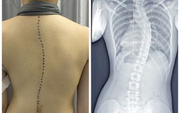 Cảnh báo học sinh, sinh viên cột sống cong chữ S, lồng ngực biến dạng