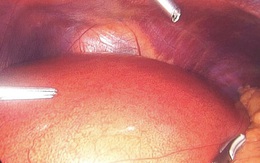 Không chỉ người béo mà cả người gầy cũng đầy… mỡ nội tạng