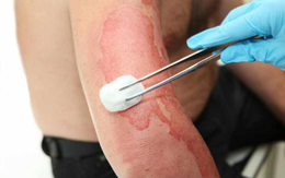 Bị bỏng phải kiêng trứng, thịt bò để vết sẹo 'đẹp', có đúng?