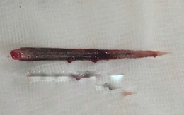 Hy hữu, một người bị đuôi cá đuối đâm thủng phổi