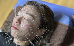 'Hóa nhím' vì phương pháp châm cứu thời thượng