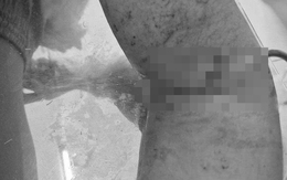 Nối thành công động mạch cánh tay cho bệnh nhân ở Phú Quốc