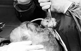 Bệnh viện Đa khoa Thủ Đức cắt thành công khối u xơ tử cung 4,5kg