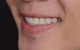 Bác sĩ hướng dẫn người niềng răng vệ sinh khay niềng sạch bóng tại nhà