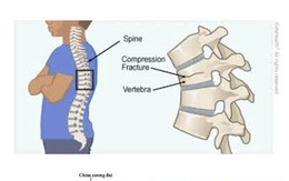 Loãng xương - căn bệnh bị xem nhẹ nhưng tỉ lệ tử vong cao