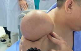 ‘Gỡ bỏ’ khối u vai khổng lồ