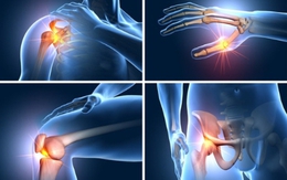 Thoái hóa khớp giai đoạn sớm: Nên bắt đầu bằng thuốc bôi tại chỗ và tập luyện