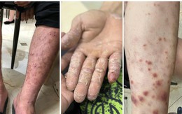 5 bệnh da liễu thường gặp trong mùa mưa lũ và cách xử lý