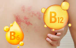 Có thể chăm sóc và hỗ trợ chữa trị người bệnh zona thần kinh bằng thực phẩm?