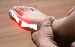 Đau do bệnh gút, các liệu pháp điều trị tự nhiên