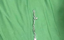 Bé gái 5 tuổi nuốt vòng tay bạc dài 7cm, sơ cứu đúng cách giúp trẻ thoát nguy hiểm