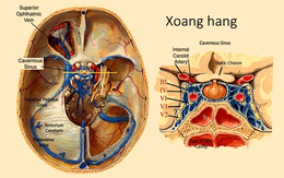 Ngạt mũi, đau đầu, thanh niên 25 tuổi nhập viện vì nhiễm trùng sọ