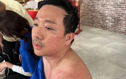 Trấn Thành bị thương tích đầy người: Ok! Không sao hết, Hai ổn!