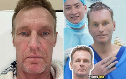 'Nổi như cồn' sau khi phẫu thuật thẩm mỹ ở Việt Nam