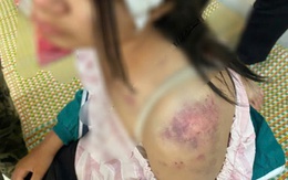 Bé gái bị bà nội, ông dượng và anh trai bà nội đánh đập dã man