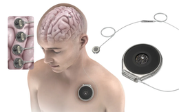 Đối thủ của Neuralink được thử nghiệm cấy chip vào não người