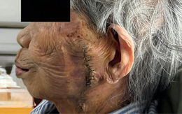 Phẫu thuật cắt bỏ khối ung thư lớn trên mặt cụ bà 99 tuổi