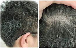 Có phải ‘tóc bạc nhiều là dấu hiệu của ung thư’?