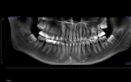Bác sĩ hướng dẫn tránh sai lầm sau nhổ răng khôn - 'vị khách' đến muộn nhiều phiền toái
