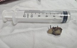 Bỗng dưng mất 2 chiếc răng, 20 năm sau bác sĩ phát hiện trong... phổi